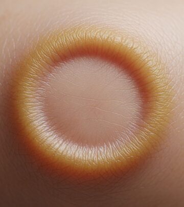 Rare childhood skin disorder with circumscribed hyperkeratotic plaques on elbows, knees, and other sites.