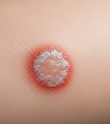 Comprehensive guide to genital psoriasis: symptoms, causes, diagnosis, and effective treatments for improved quality of life.